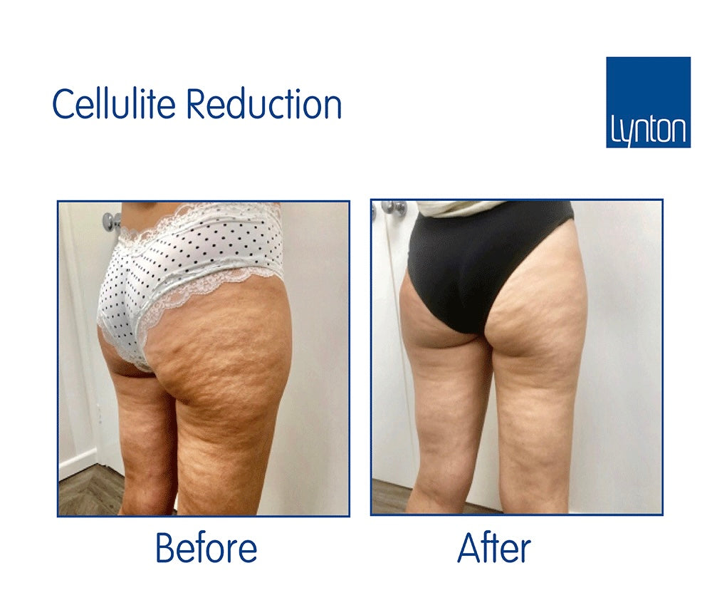 CELLULITE REDUCTION