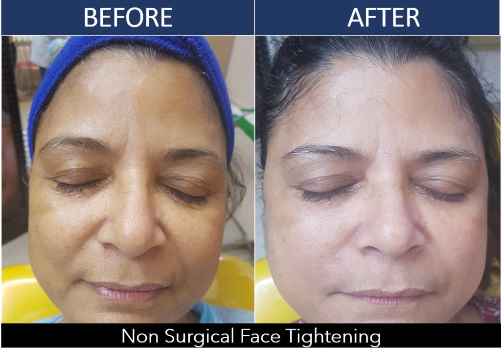 SKIN TIGHTENING